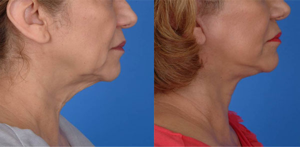 Facelift-before-and-after