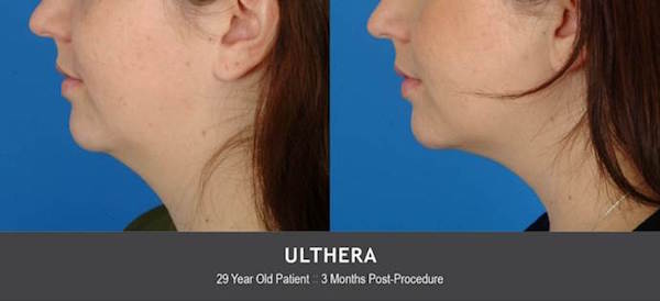 Ulthera before and after social