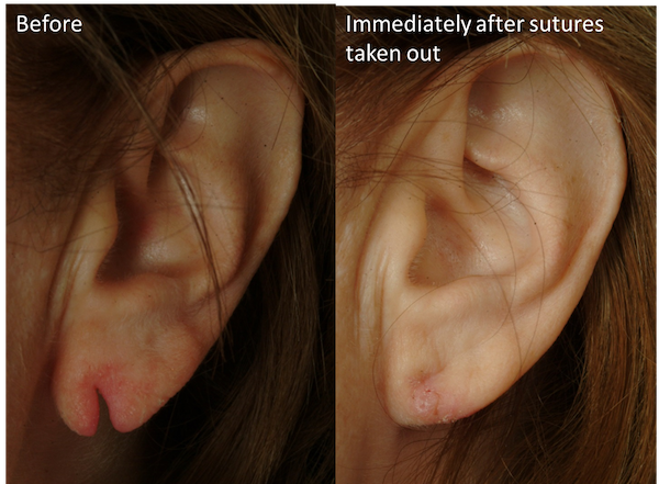 earlobe repair1