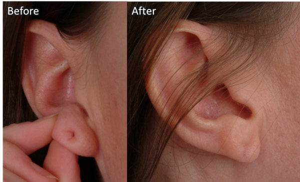 earlobe repair2