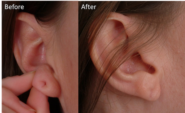 Earlobe Reduction Surgery - Houston Earlobe Surgeon